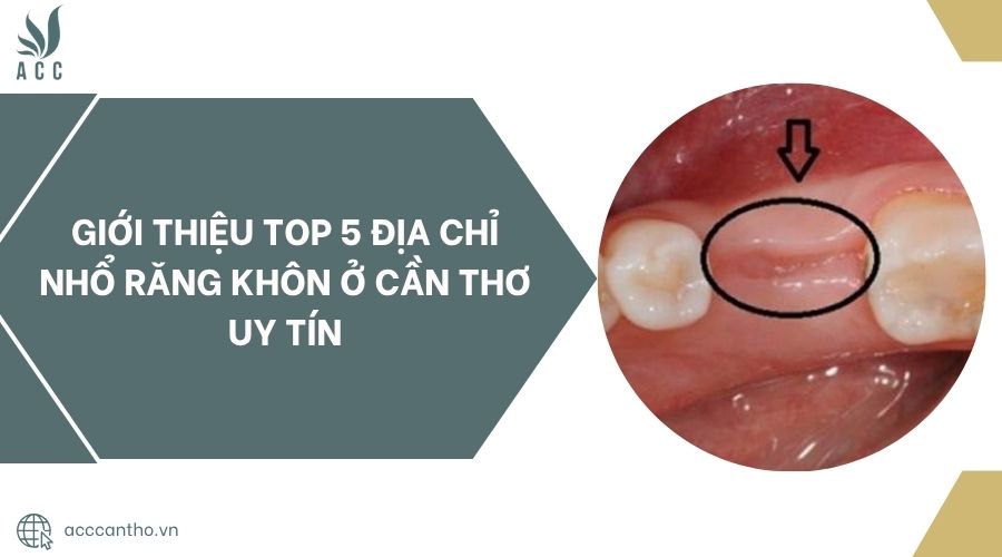 Giới thiệu top 5 địa chỉ nhổ răng khôn ở Cần Thơ uy tín.jpg