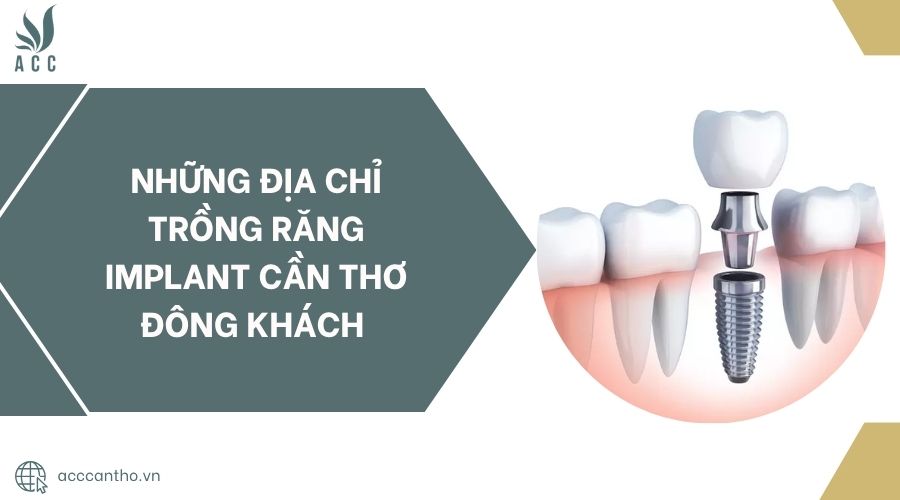 Những địa chỉ trồng răng Implant Cần Thơ đông khách.jpg